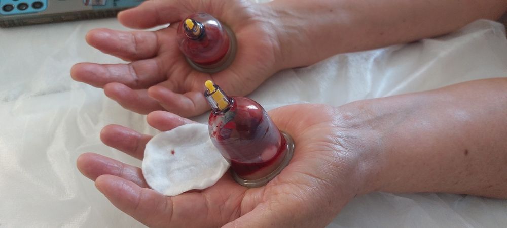 Хиджама/қан шыгару