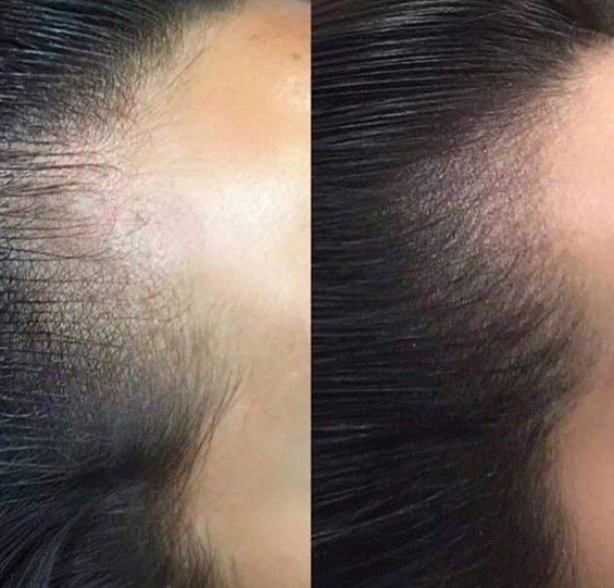 Трихопедментация головы