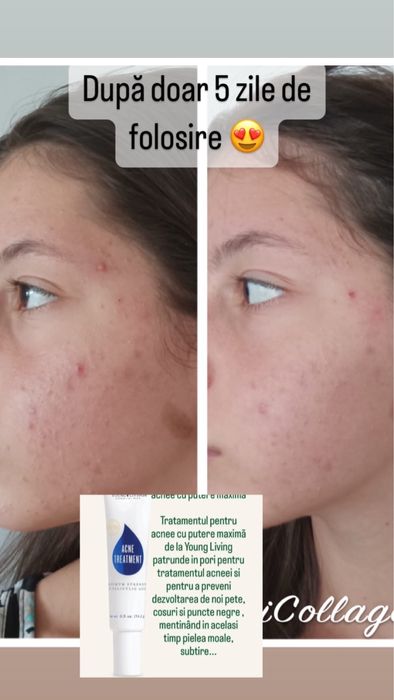 Crema pentru acnee young living