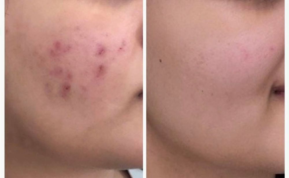 Tratament cosuri  nu skin
