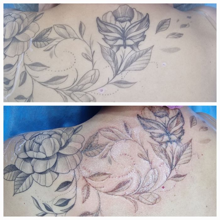 Удаление татуировок  и татуажа