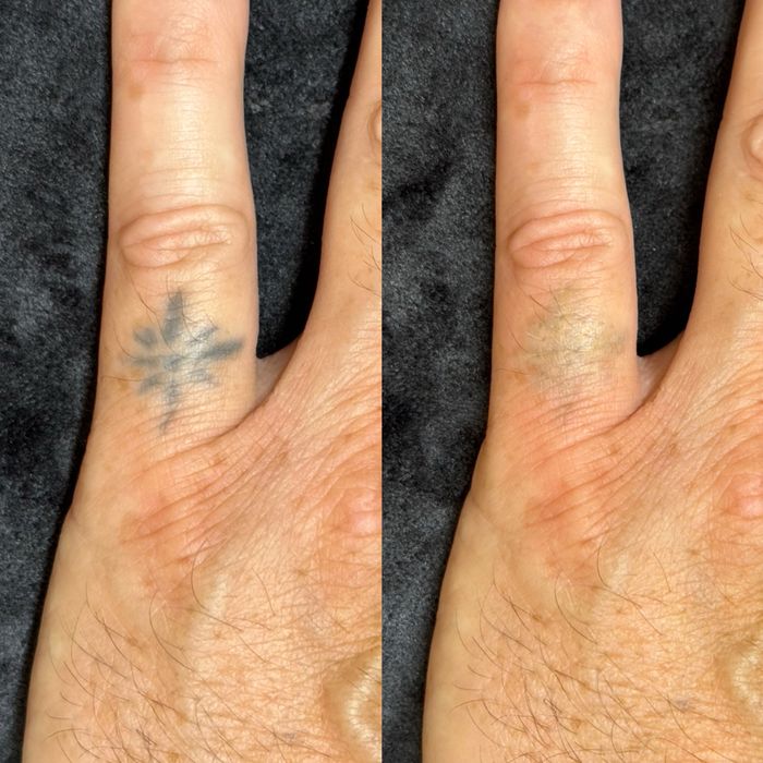 Лазерное удаление татуажа