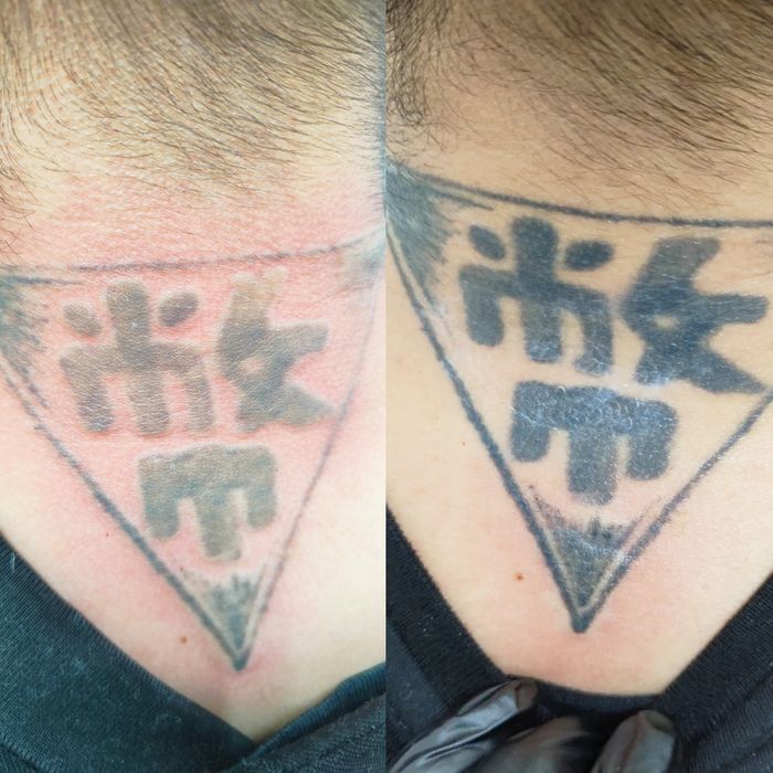 Удаление татуажа, тату