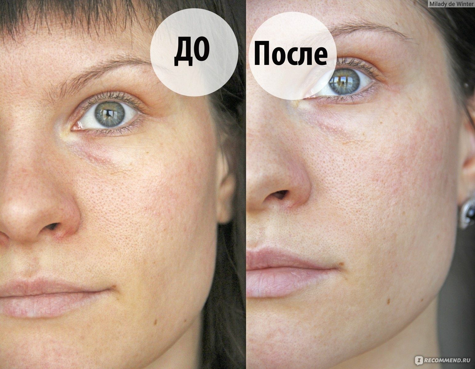 Лицо после коллагена фото Лицо после коллагена фото