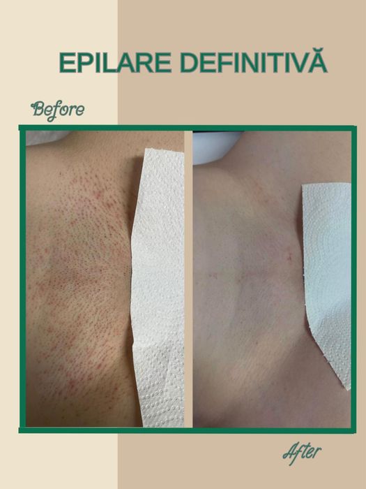 Epilare definitivă