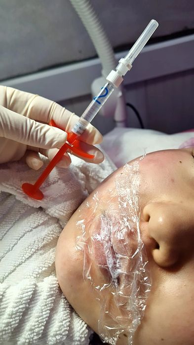 Увеличение губ Косметолог