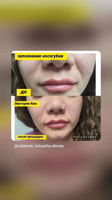 Увеличение губ заполнение носогубки