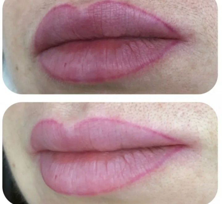 Удаление лазером тату от 5000