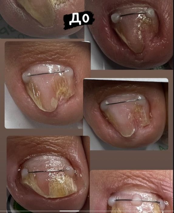 Подология лечение стоп и ногтей