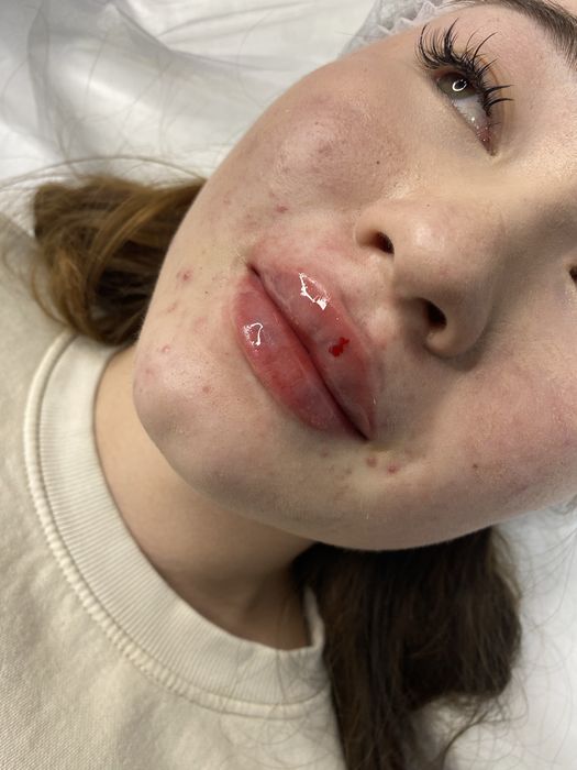 Акция Увеличение Губ