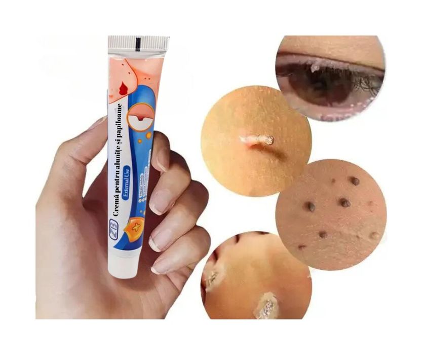 Crema pentru eliminarea papiloamelor