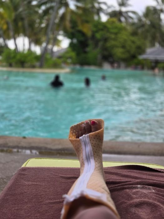 Гипс съёмный,  можно одеть на море , бассейн