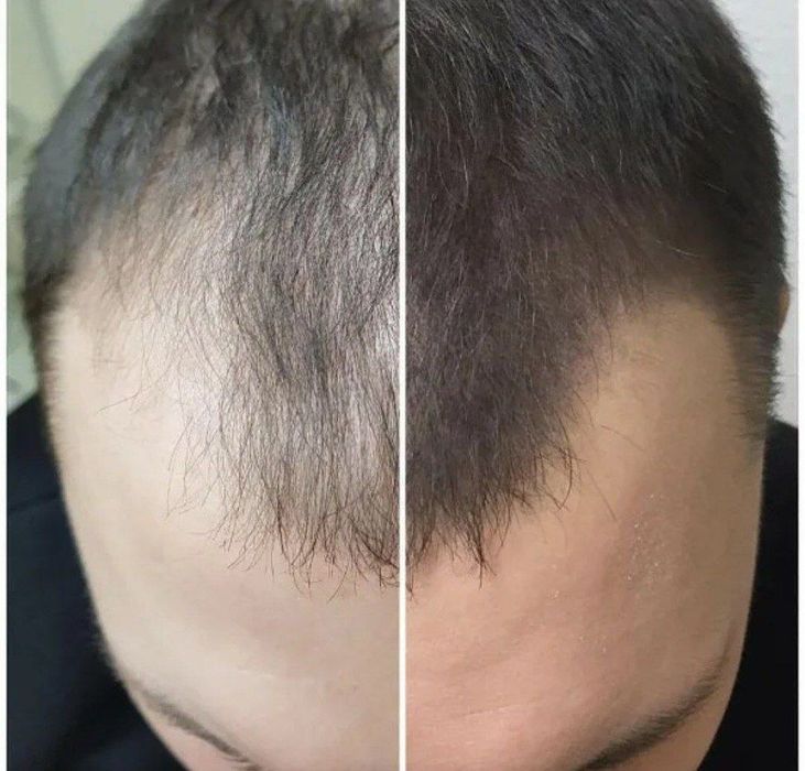 Трихопедментация головы