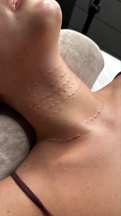 Контурная пластика губ