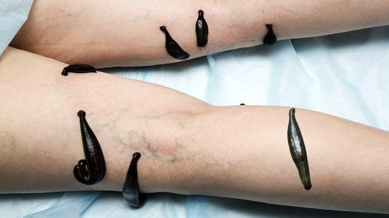 Гирудотерапия.Лечение Пиявками,