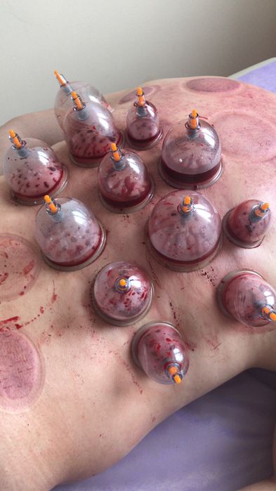 Банки Хиджамы 5тыс  Лезвие 5000тг