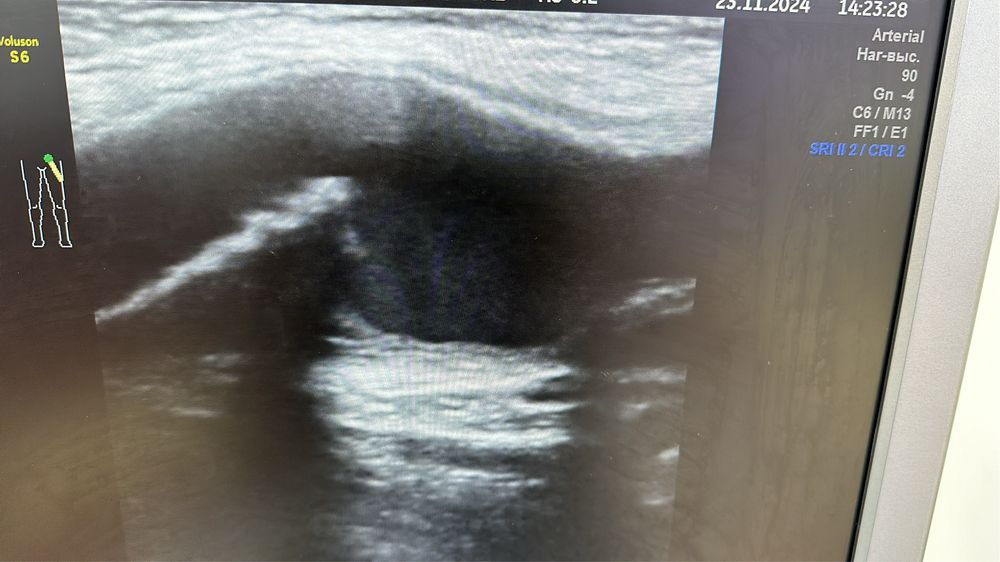 УЗИ (Уздг) сосудов
