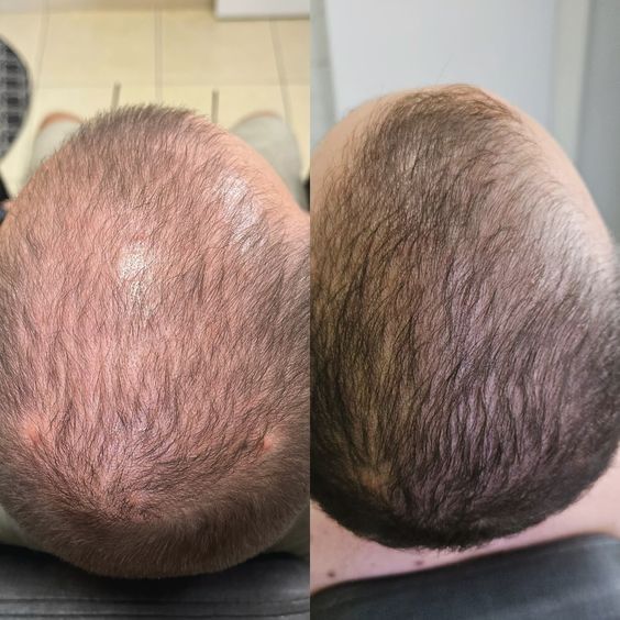 Soch tushishi yoki alopesiya bilan qiynalayapsizmi?Shifokor dermatolog