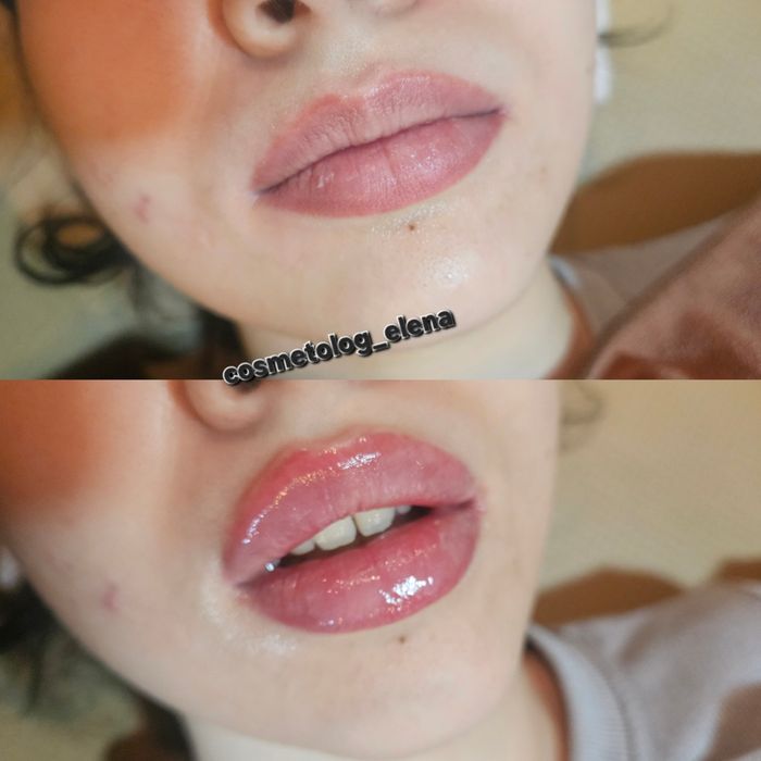 Увеличение губ. Филлер юж. Корея.