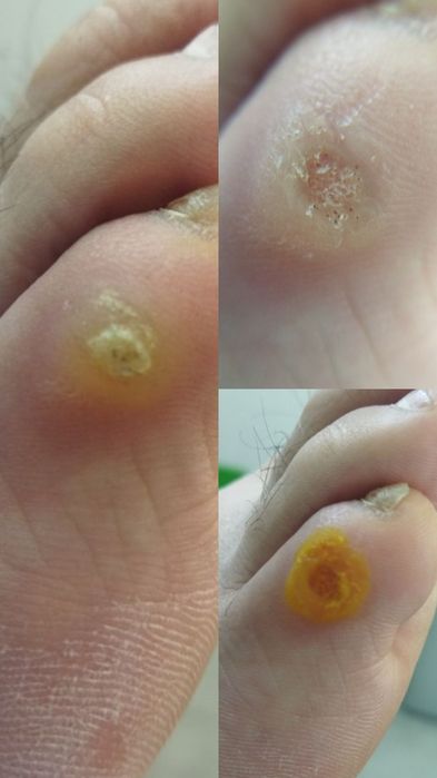 Педикюр, подолог