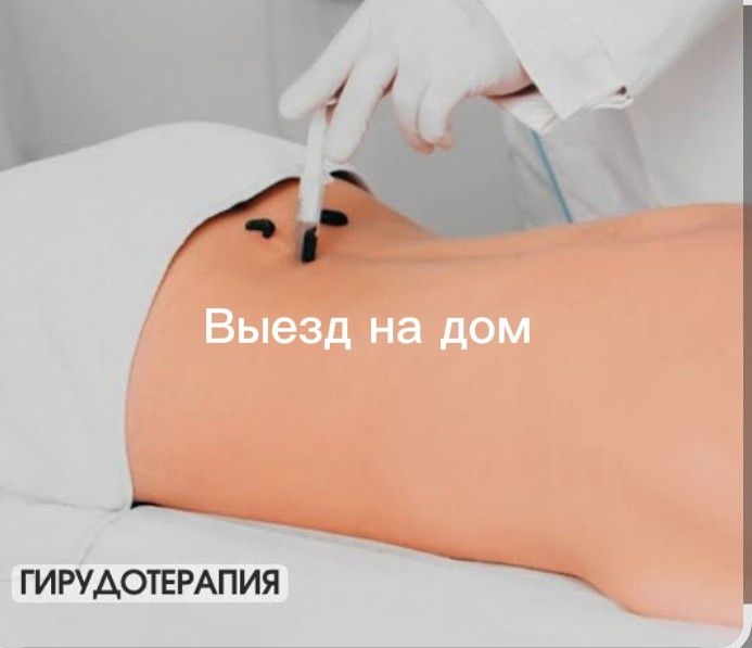 Гирудотерапия Сулик емдеу