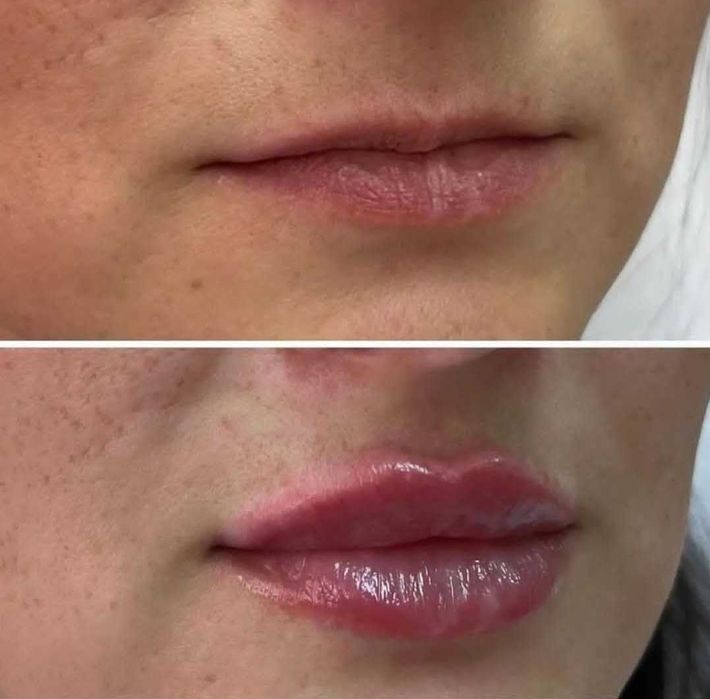 Акция на косметологические процедуры. Скидки до 50%