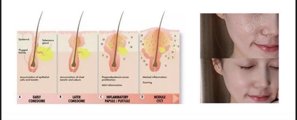 LED PDT лампа для лица