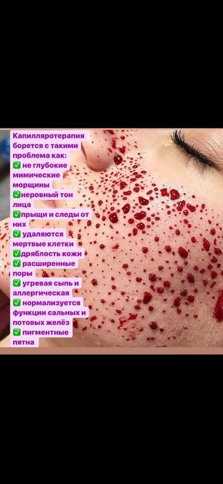 Хиджама Капиляротеропия