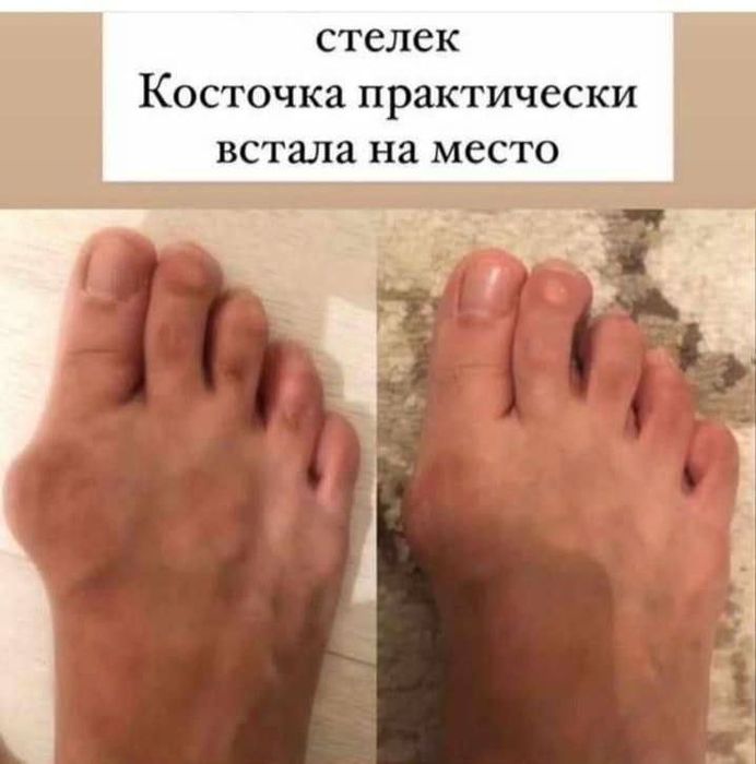 Стельки коррекционные в наличии