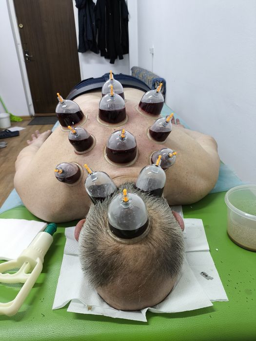 Шертпе, хиджама, ангина с выездом Алматы