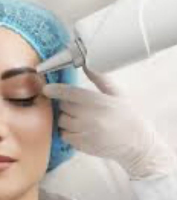 Сергели , Удаление татуажа , карбоновый пилинг, удаление пигментации