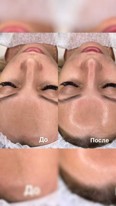 Лифтинг хиджама в Актобе