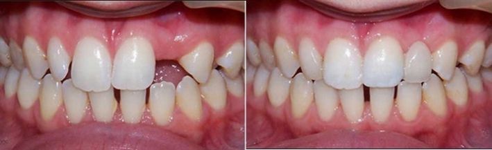 Зубные протезы микро протезы