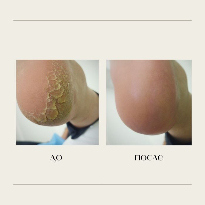 Педикюр, подолог