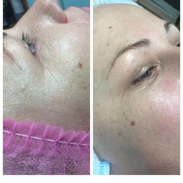 Миндальный пилинг. Увлажнение , сияние, омоложение