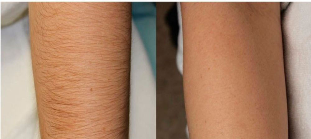 Услуга депиляции качественно и дёшова.