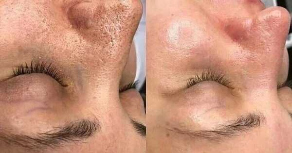 Чистка лица, Yuz tozalash, косметолог.