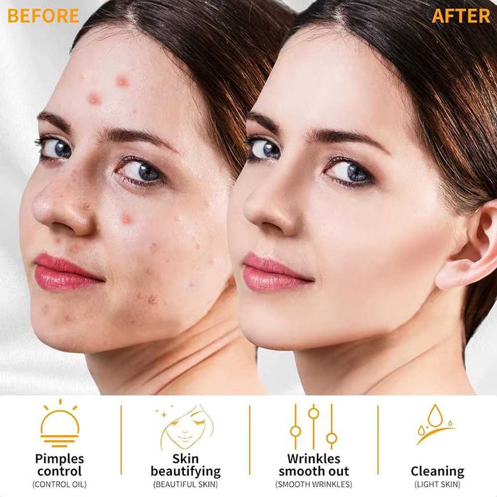 Дарсонвал - Козметичен апарат за повърхностна дезинфекция.