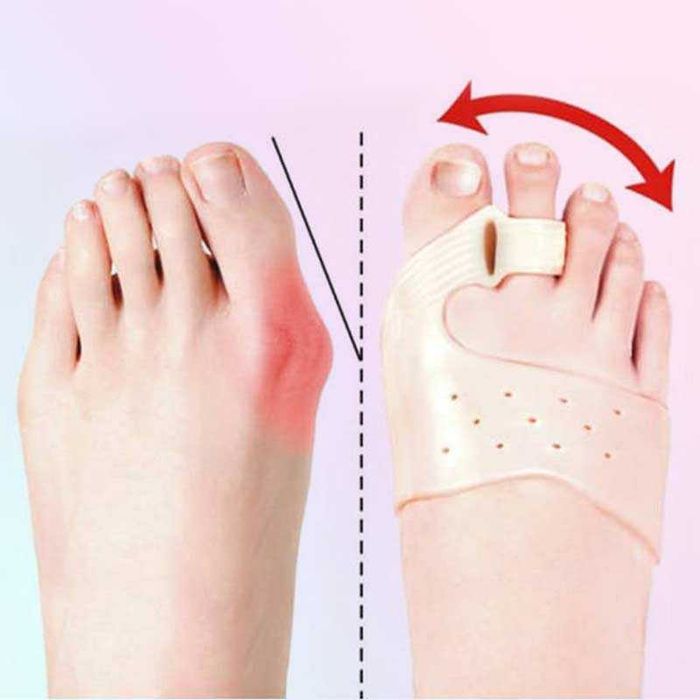 Разделители шини за коригиране на пръсти на краката, Ортеза коректор