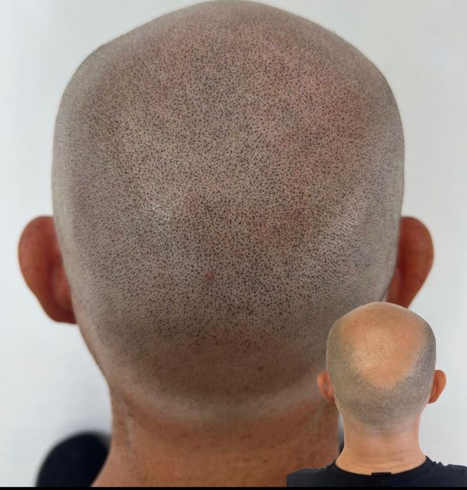 Micropigmentare scalp tricopigmentare efect indesire par alopecie SMP
