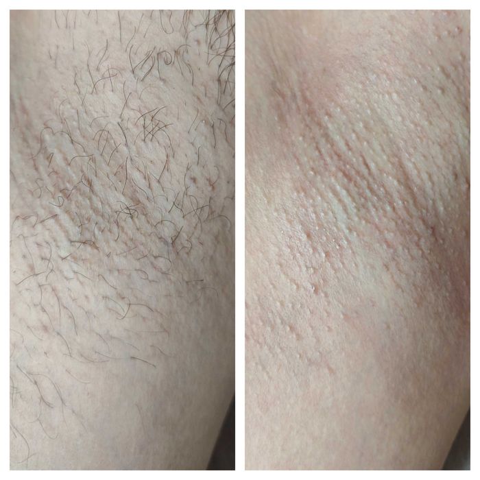 Sugaring , epilare cu zahar, depilare pentru femei si barbati