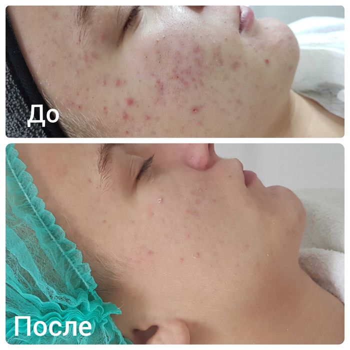 Чистка лица, Yuz tozalash, косметолог.