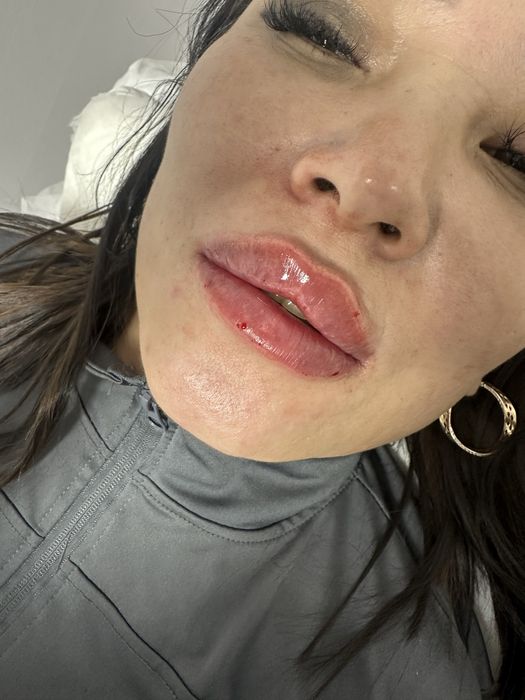 Акция Увеличение Губ