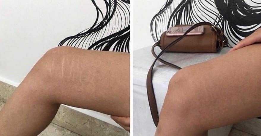 Тату,татуировка,ветелиго ,шрамы,расстяжки, курсы тату обучение!