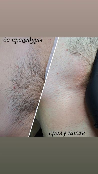 Депиляция епилатция для мужчин
