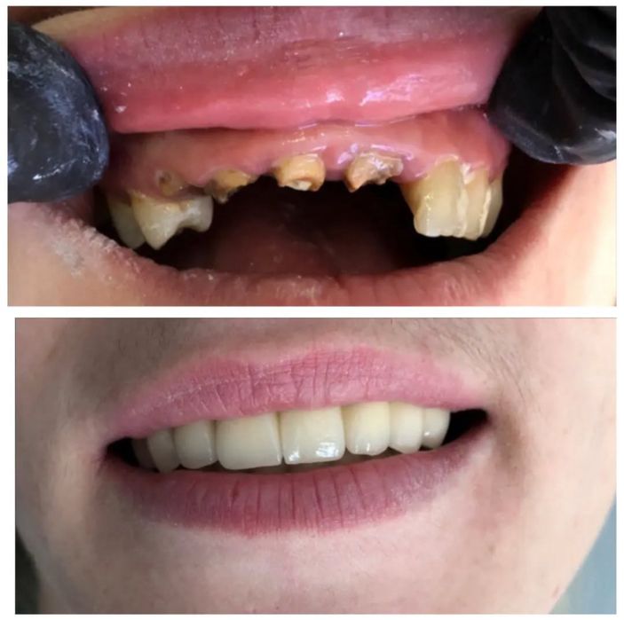 Протезы ,Циркон, Керамика , Виниры!