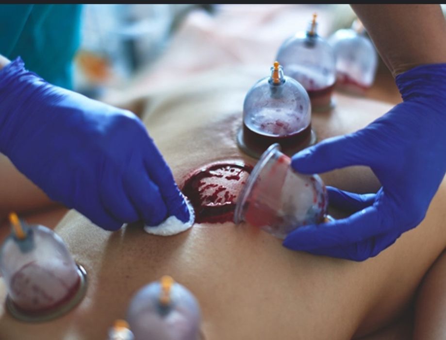 Хиджама для всех. Без боли. С выездом на дом