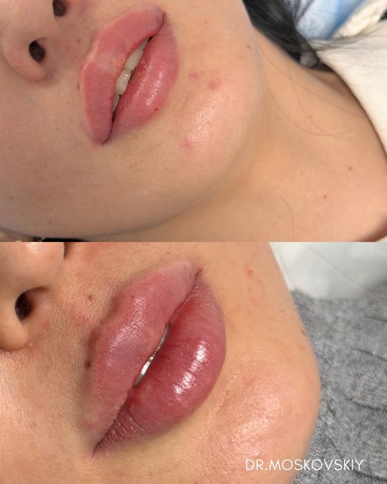 Увеличение губ|Алмата АКЦИЯ