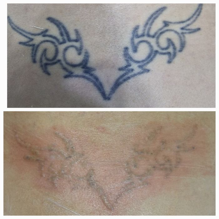 Удаление татуировок любой сложности от 200 тысяч сум