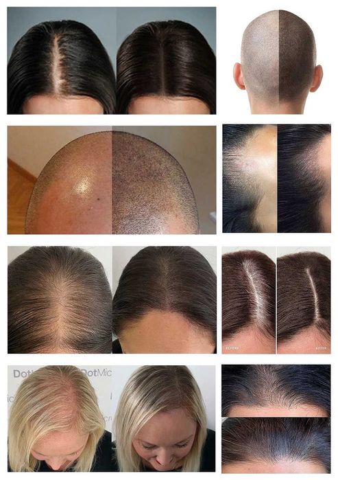 Caut modele pt micro pigmentare SMP scalp chelie / păr rar - tarif mic